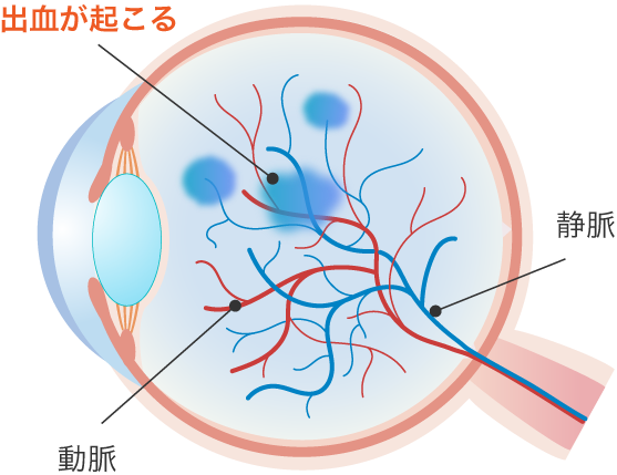 網膜静脈閉塞症の眼